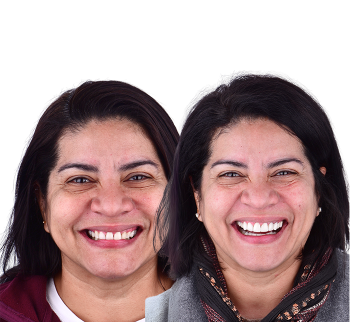 Before and After Patient 1