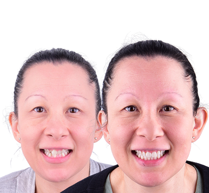 Before and After Patient 2