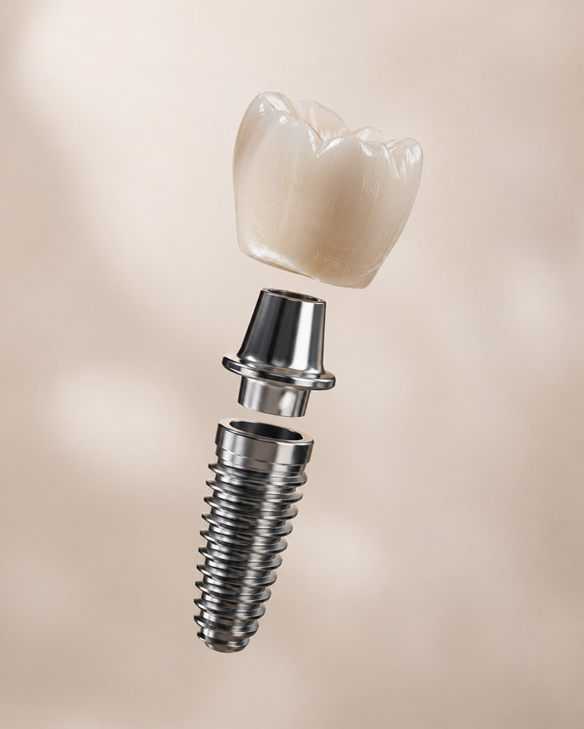 Single Dental Implants