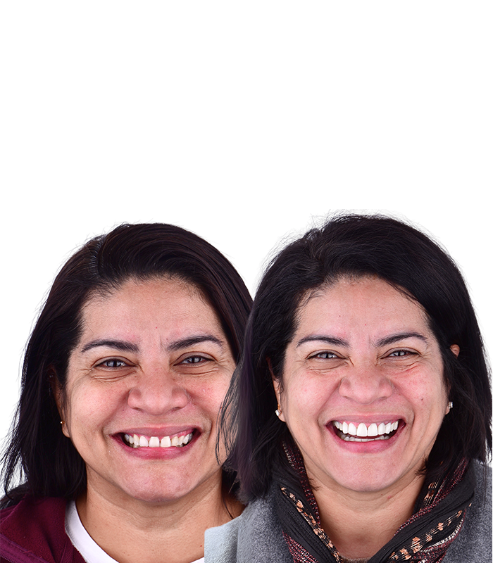 Before and After Patient 1