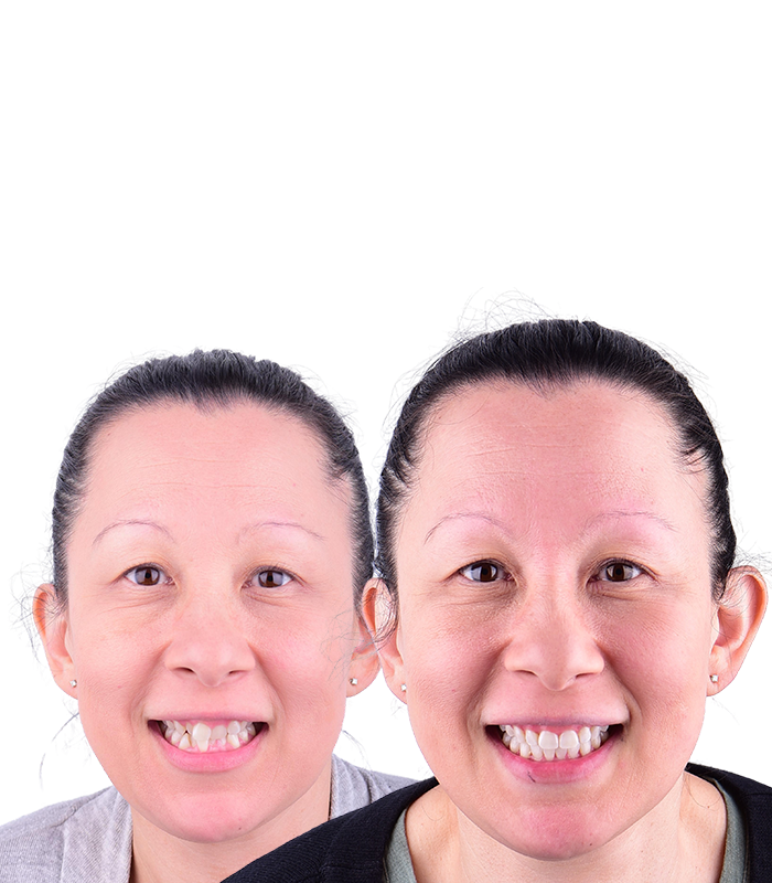 Before and After Patient 2